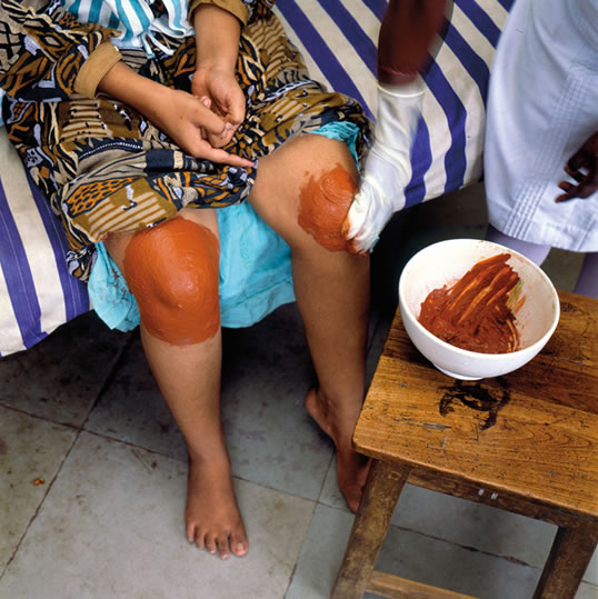 At the government Nizamia Unani Hospital in Hyderabad, India, an arthritis patient receives treatment. 